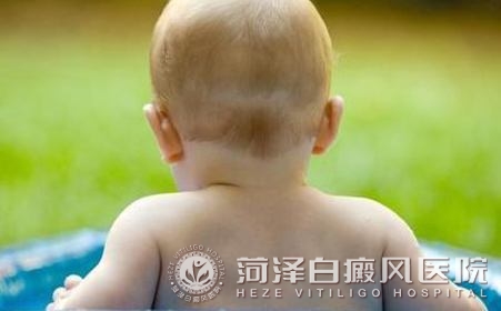 山(shān)東菏澤白癜風高(gao)等(deng)專(zhuan)科(ke)醫(yī)院